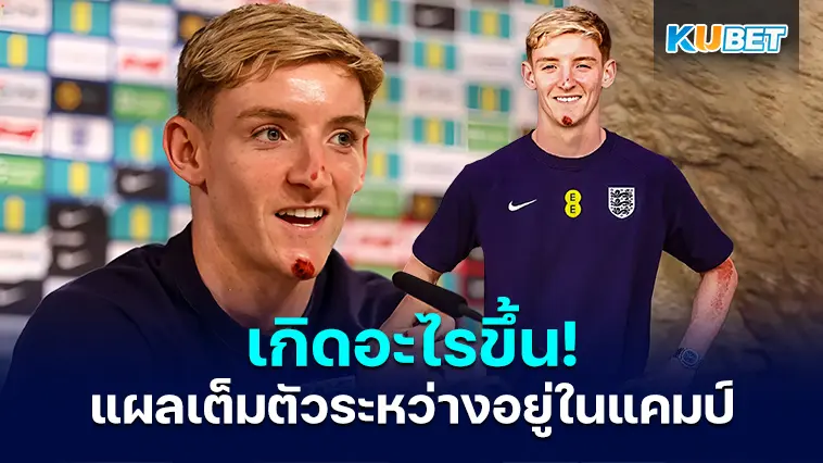 แผลเต็มตัว แอนโธนี กอร์ดอน เผยจักรยานคว่ำในแคมป์ทีมชาติ- KUBET